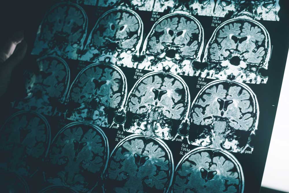 Brain scan of Alzheimers patient. Mental health concept.